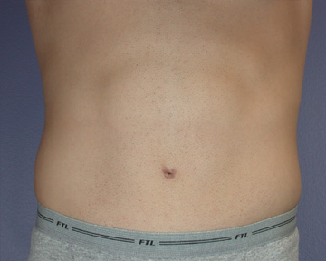 Tummy Tuck before and after photo