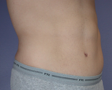 Tummy Tuck before and after photo