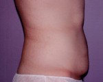 Tummy Tuck Before and after photo