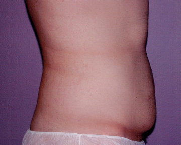 Tummy Tuck before and after photo