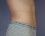 Tummy Tuck Before and after photo