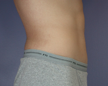 Tummy Tuck before and after photo