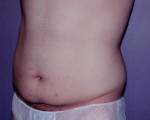 Tummy Tuck Before and after photo