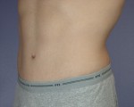 Tummy Tuck Before and after photo