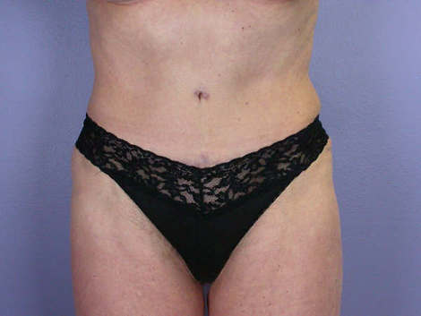 Tummy Tuck before and after photo