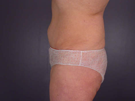 Tummy Tuck before and after photo