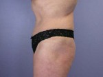 Tummy Tuck Before and after photo