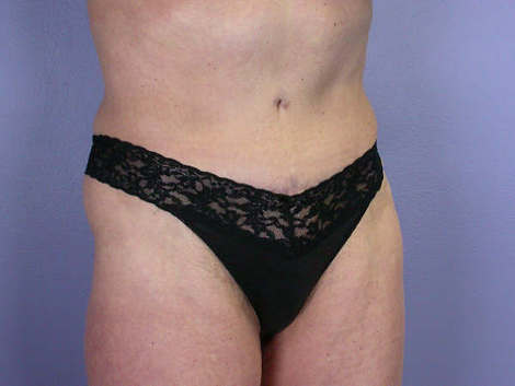 Tummy Tuck before and after photo