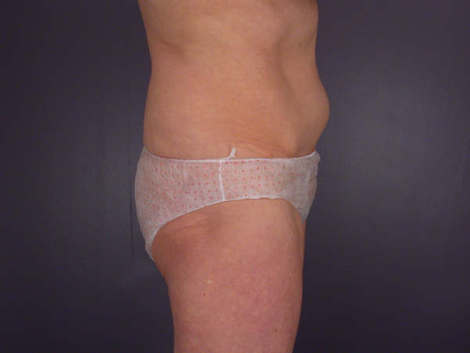 Tummy Tuck before and after photo