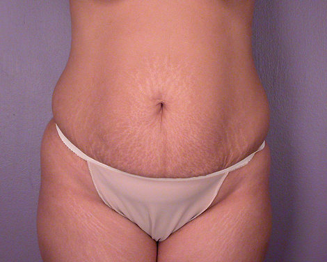 Tummy Tuck before and after photo