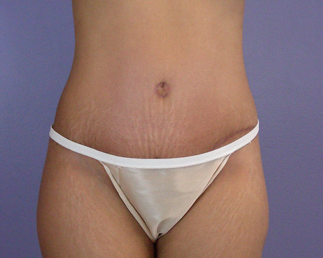 Tummy Tuck before and after photo