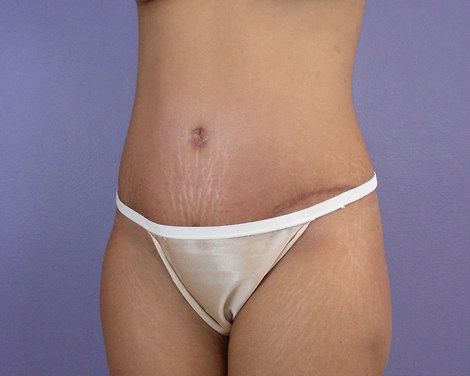 Tummy Tuck before and after photo