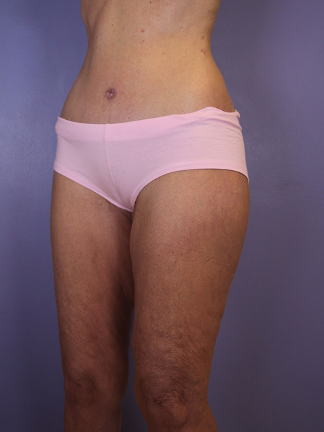 Tummy Tuck before and after photo