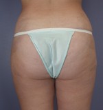 Tummy Tuck Before and after photo