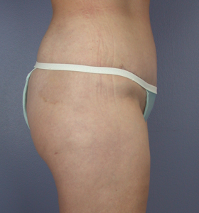 Tummy Tuck before and after photo