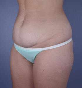 Tummy Tuck before and after photo