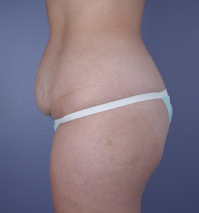 Tummy Tuck before and after photo