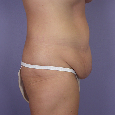 Tummy Tuck before and after photo