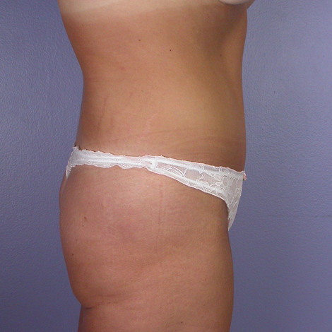 Tummy Tuck before and after photo