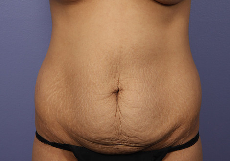 Tummy Tuck before and after photo