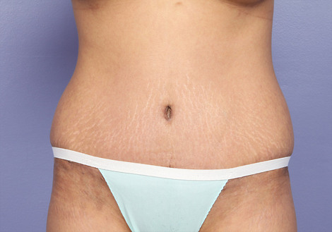 Tummy Tuck before and after photo