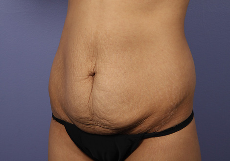 Tummy Tuck before and after photo