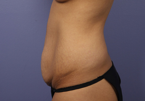 Tummy Tuck before and after photo