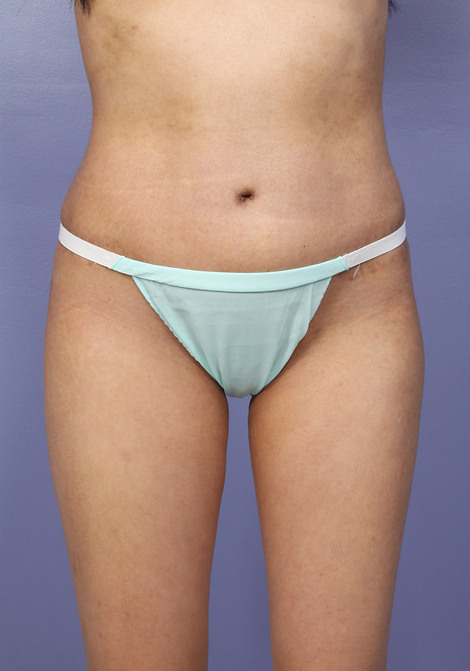 Tummy Tuck before and after photo