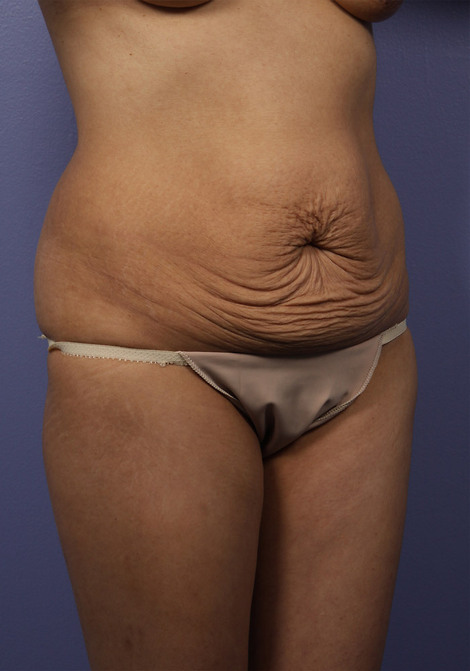 Tummy Tuck before and after photo