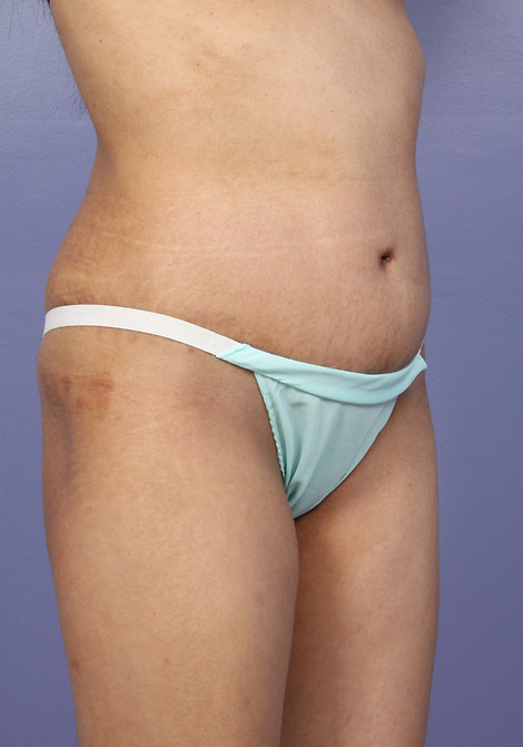 Tummy Tuck before and after photo