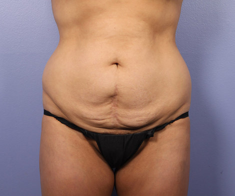 Tummy Tuck before and after photo