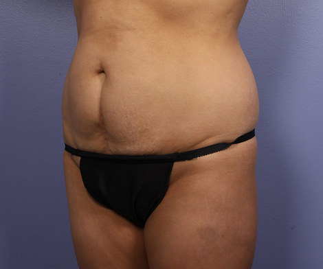 Tummy Tuck before and after photo