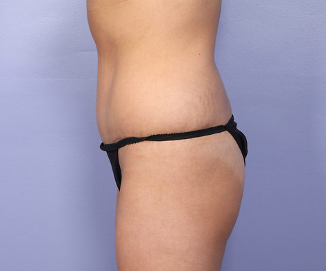 Tummy Tuck before and after photo