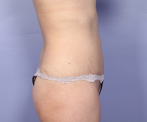 Tummy Tuck before and after photo