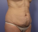 Tummy Tuck Before and after photo