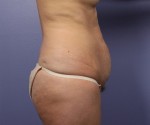 Tummy Tuck Before and after photo