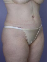 Tummy Tuck Before and after photo