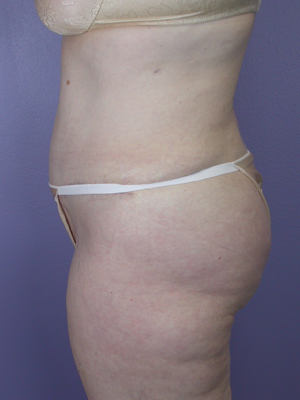 Tummy Tuck before and after photo