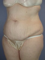 Tummy Tuck Before and after photo