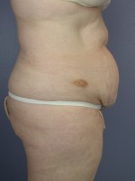 Tummy Tuck Before and after photo