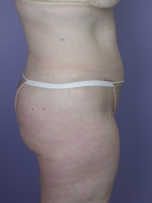 Tummy Tuck before and after photo