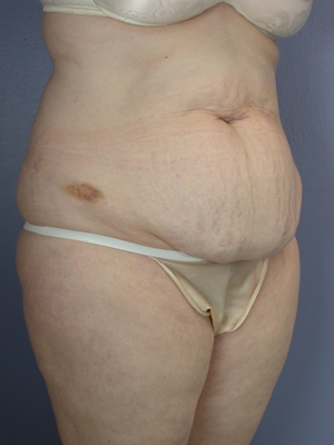 Tummy Tuck before and after photo