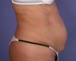 Tummy Tuck Before and after photo