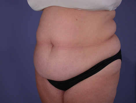 Tummy Tuck before and after photo