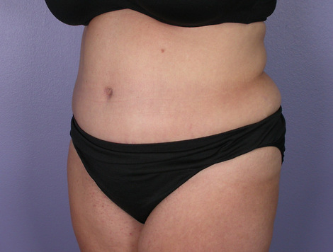 Tummy Tuck before and after photo