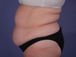 Tummy Tuck Before and after photo