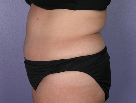 Tummy Tuck before and after photo