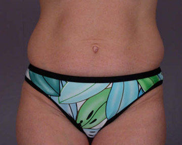 Tummy Tuck before and after photo