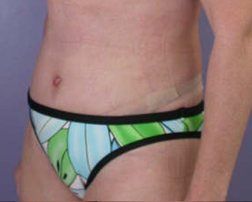 Tummy Tuck before and after photo