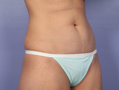 Tummy Tuck before and after photo